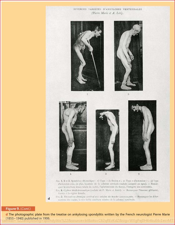 afbeeldingen spondylitis in het werk van Pierre Marie (1906)