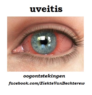 uveitis