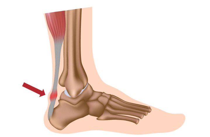 ACHILLES-TENDONITIS