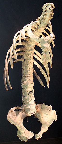 tn_Spondylitis_ankylosans_bechterew)_anagoria